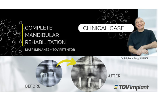 Réhabilitation mandibulaire complète par implants MAER et système Retentor TOV Implant